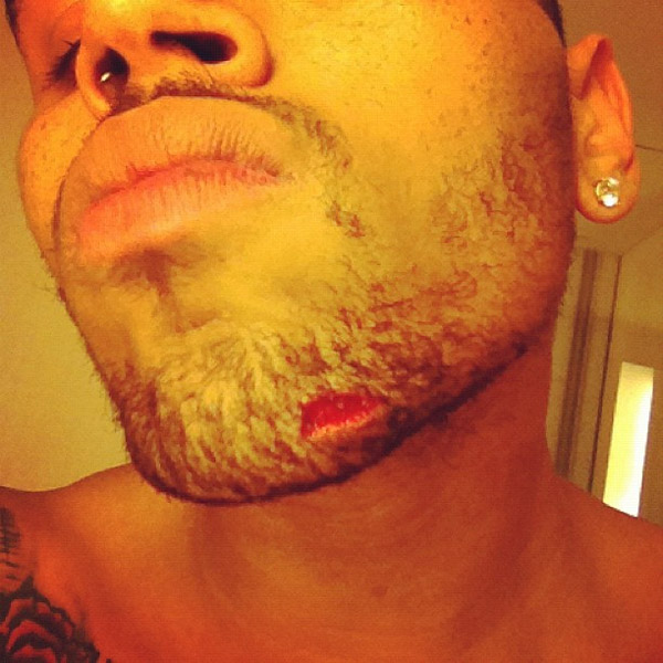 Chris Brown was left bloodied after a bar brawl with Drake, who was reported to have boasted about having sex with Rihanna. But that's nothing compared to other music injuries...